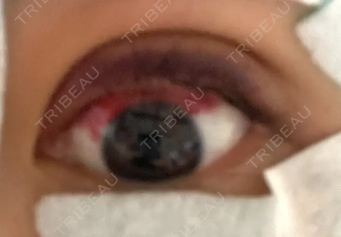 二重埋没 湘南美容クリニック 京都院 DAY 2 メイン用