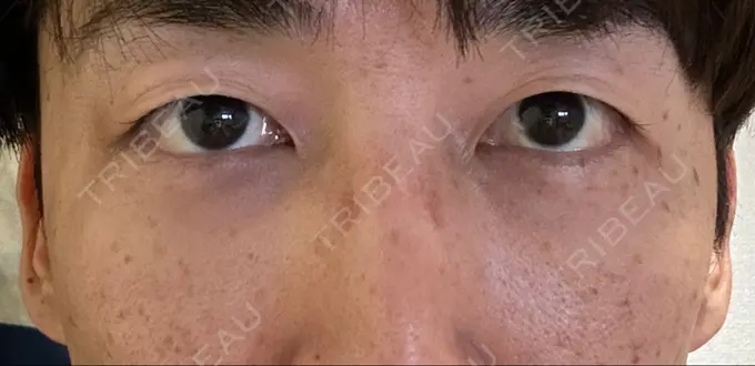 下まぶたたるみ取り / 脂肪注入（目の下） 湘南美容クリニック 池袋東口院 DAY 7 メイン用