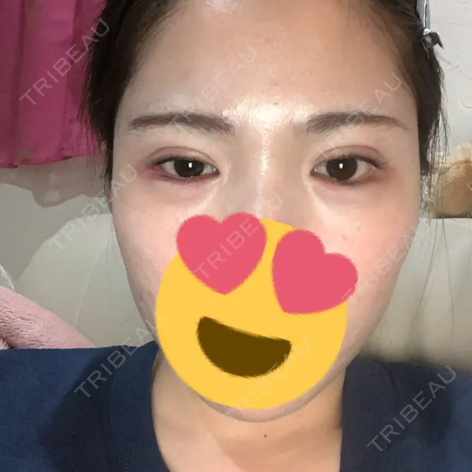 ヒアルロン酸注入（涙袋） / ボトックス（タレ目） フィラークリニック 渋谷院 AFTER メイン用