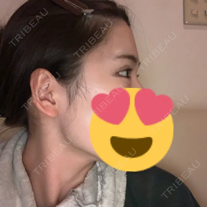 ヒアルロン酸注入（涙袋） / ボトックス（タレ目） フィラークリニック 渋谷院 DAY 4 メイン用