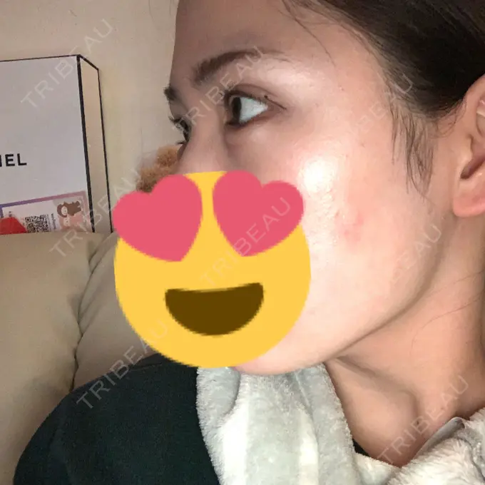 ヒアルロン酸注入（涙袋） / ボトックス（タレ目） フィラークリニック 渋谷院 DAY 4 メイン用