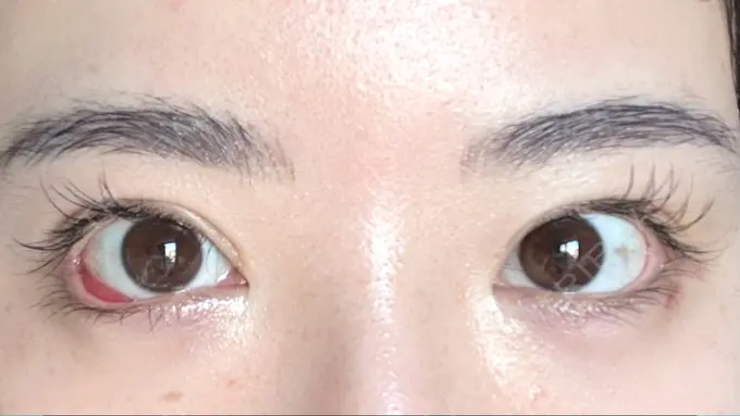 目尻切開 / タレ目形成・グラマラスライン（埋没） LOUIS CLINIC 二子玉川院【ルイクリニック】 DAY 9 メイン用