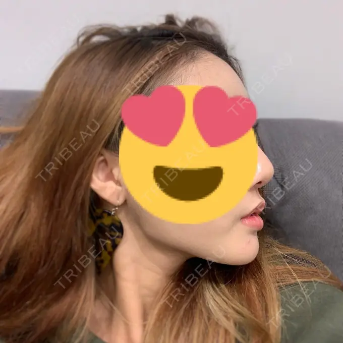 バッカルファット除去 / 脂肪吸引（顔） / 額を丸く / ヒアルロン酸注入（あご） / ボトックス（エラ・小顔） / ヒアルロン酸注入（額） エートップ美容整形外科 DAY 63 メイン用