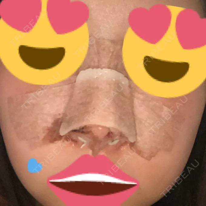 隆鼻術 / 鼻尖形成（切開） / 小鼻縮小（切開） / 軟骨移植 / 鼻翼挙上 / 鼻柱下降・鼻唇角形成（猫手術） Designo Clinic （デジーノクリニック） DAY 2 メイン用