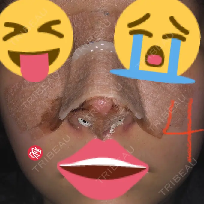 隆鼻術 / 鼻尖形成（切開） / 小鼻縮小（切開） / 軟骨移植 / 鼻翼挙上 / 鼻柱下降・鼻唇角形成（猫手術） Designo Clinic （デジーノクリニック） DAY 4 メイン用