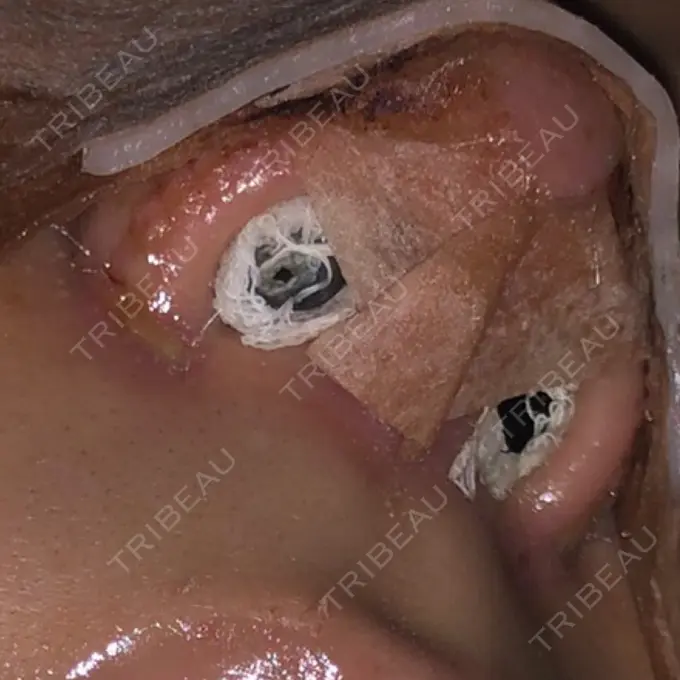 隆鼻術 / 鼻尖形成（切開） / 小鼻縮小（切開） / 軟骨移植 / 鼻翼挙上 / 鼻柱下降・鼻唇角形成（猫手術） Designo Clinic （デジーノクリニック） DAY 4 メイン用