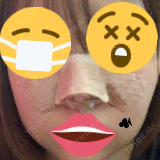 隆鼻術 / 鼻尖形成（切開） / 小鼻縮小（切開） / 軟骨移植 / 鼻翼挙上 / 鼻柱下降・鼻唇角形成（猫手術） Designo Clinic （デジーノクリニック） DAY 7 メイン用