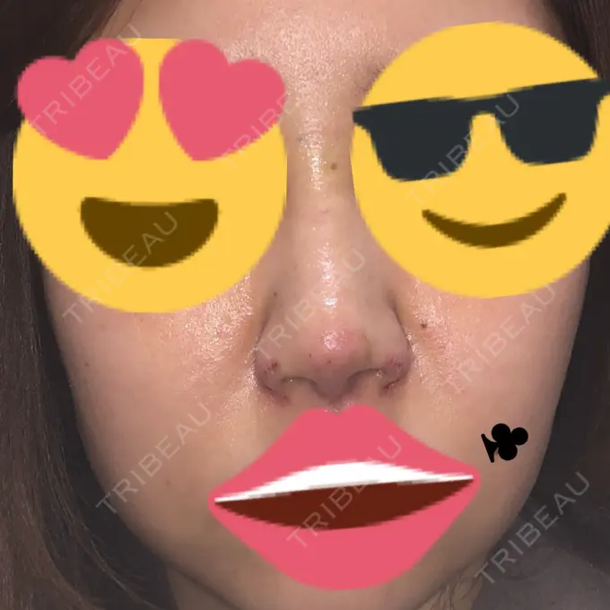 隆鼻術 / 鼻尖形成（切開） / 小鼻縮小（切開） / 軟骨移植 / 鼻翼挙上 / 鼻柱下降・鼻唇角形成（猫手術） Designo Clinic （デジーノクリニック） DAY 7 メイン用