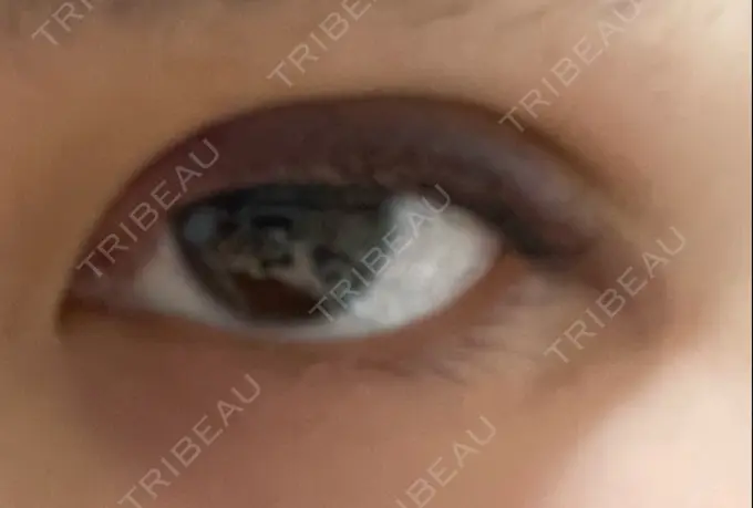 二重埋没 湘南美容クリニック 京都院 DAY 3 メイン用