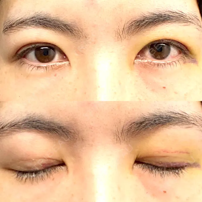 二重埋没 湘南美容クリニック 京都院 DAY 7 メイン用