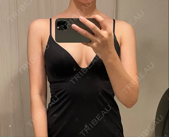 脂肪吸引（二の腕） Mods Clinic（モッズクリニック） 名古屋院 DAY 36 メイン用