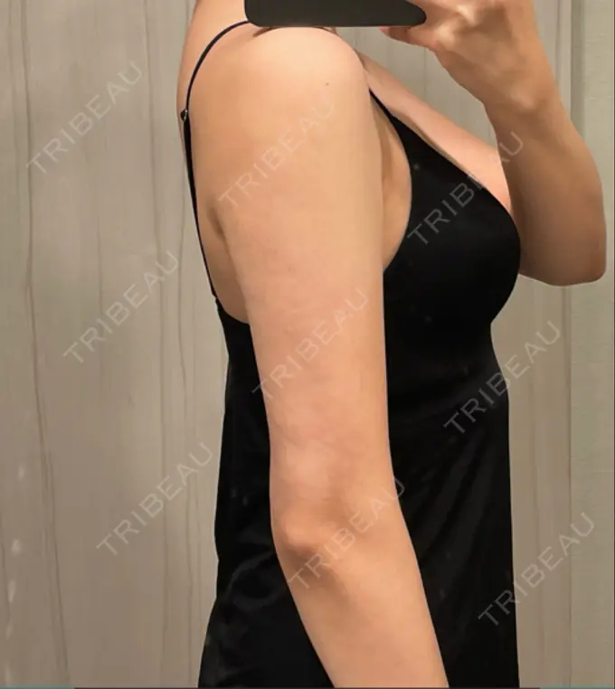 脂肪吸引（二の腕） Mods Clinic（モッズクリニック） 名古屋院 DAY 36 メイン用