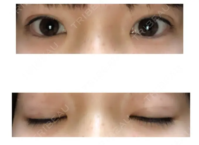 二重埋没 品川スキンクリニック広島院 DAY 12 メイン用