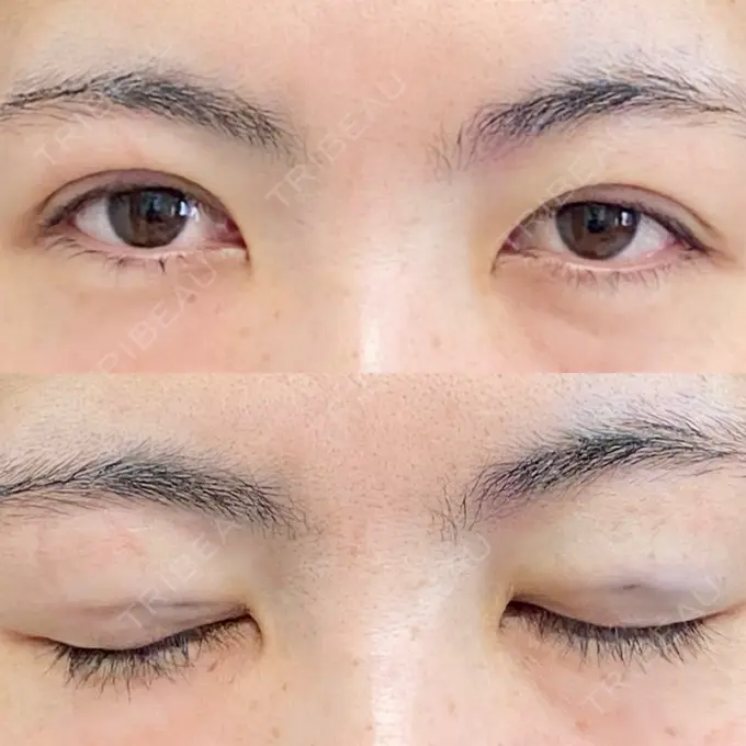 二重埋没 湘南美容クリニック 京都院 DAY 0 メイン用