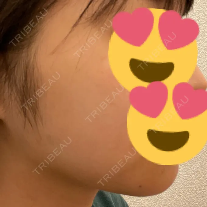 糸リフト / 脂肪吸引（顔） / ボトックス（エラ・小顔） RIVER CLINIC（リバークリニック） AFTER メイン用