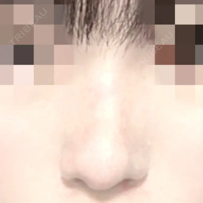 鼻尖形成（切開） / 小鼻縮小（切開） / 軟骨移植 / 鼻孔縁下降 / ヒアルロン酸注入（鼻） ziz CLINIC DAY 36 メイン用