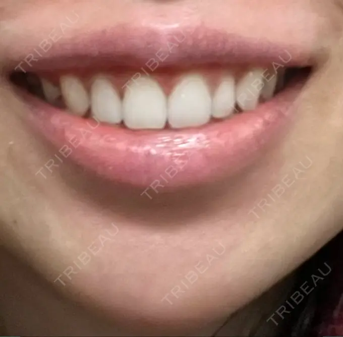 ボトックス（ガミースマイル） 椿クリニック 心斎橋院 DAY 13 メイン用