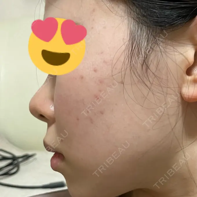 ニードルRF（ポテンツァなど） 東京美容外科 池袋院 DAY 8 メイン用