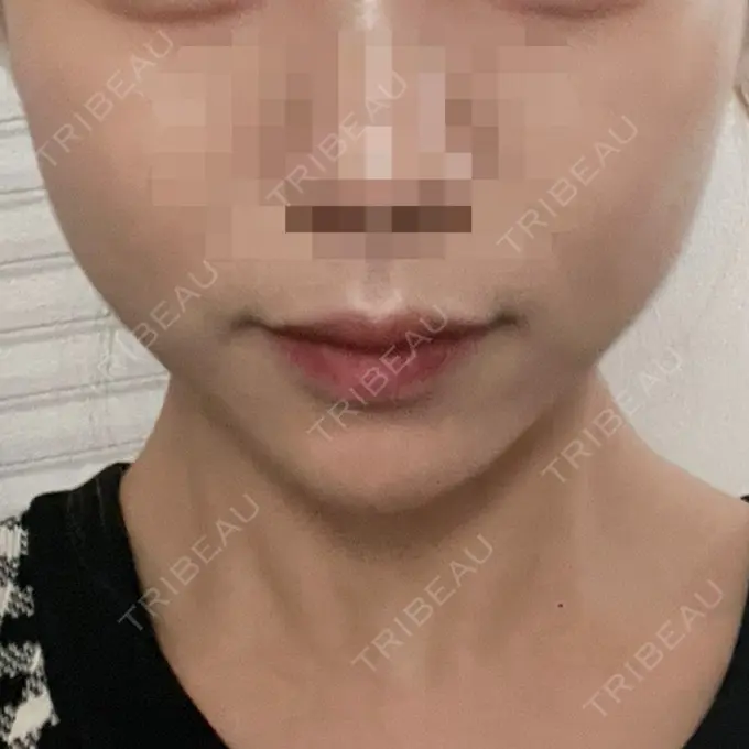 ヒアルロン酸注入（あご） / ボトックス（エラ・小顔） フィラークリニック 渋谷院 AFTER メイン用