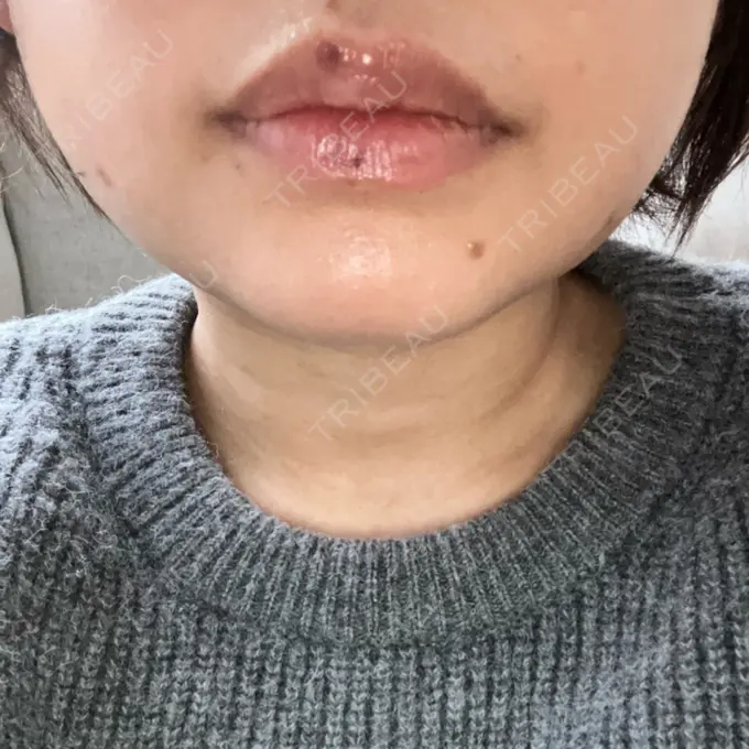 ハイフ（顔） 湘南美容クリニック 仙台院 AFTER メイン用