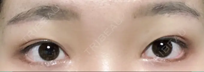 タレ目形成・グラマラスライン（切開） / 目尻靭帯移動 DIVINE（ディバイン）整形外科 DAY 25 メイン用