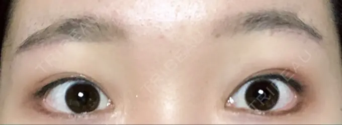 タレ目形成・グラマラスライン（切開） / 目尻靭帯移動 DIVINE（ディバイン）整形外科 DAY 25 メイン用