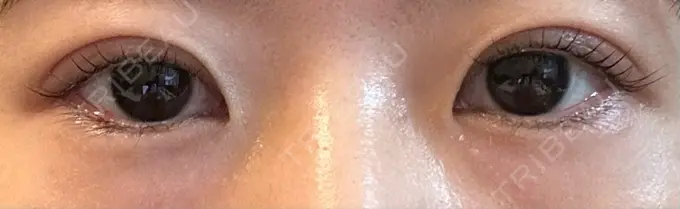 二重埋没 銀座S美容・形成外科クリニック DAY 62 メイン用