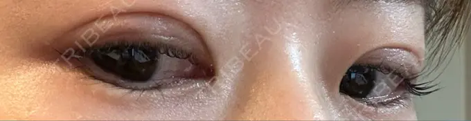 二重埋没 銀座S美容・形成外科クリニック DAY 62 メイン用