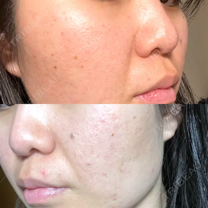 ピーリング（ニキビ・毛穴） / ポテンツァ A CLINIC（エークリニック） 仙台院 AFTER メイン用