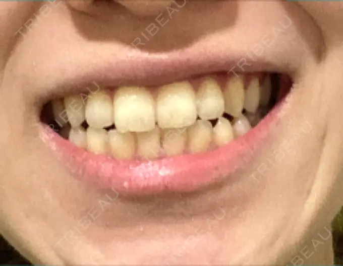 ホワイトニング オーラルビューティークリニック クラリス審美歯科・矯正歯科 DAY 31 メイン用