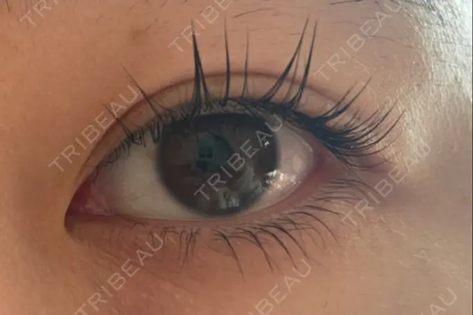 二重埋没 城本クリニック 福岡院 DAY 1237 メイン用