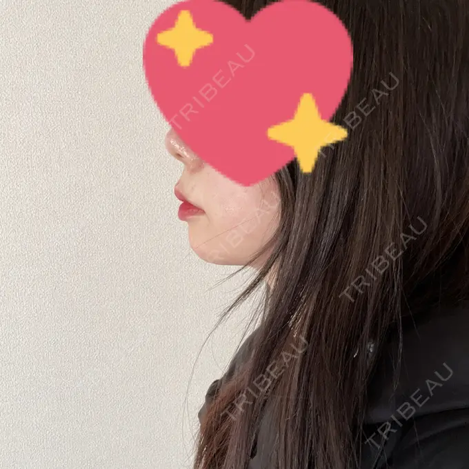 ヒアルロン酸注入（あご） 豊洲内科・糖尿病 / 形成・美容外科クリニック DAY 2 メイン用