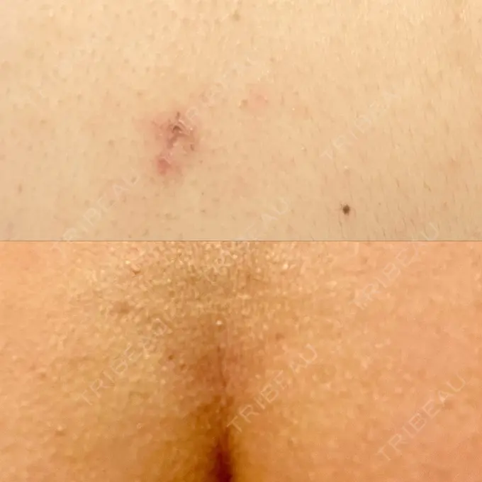 脂肪吸引（お腹） / 脂肪吸引（背中） WOM CLINIC GINZA （ワム クリニック ギンザ） DAY 24 メイン用