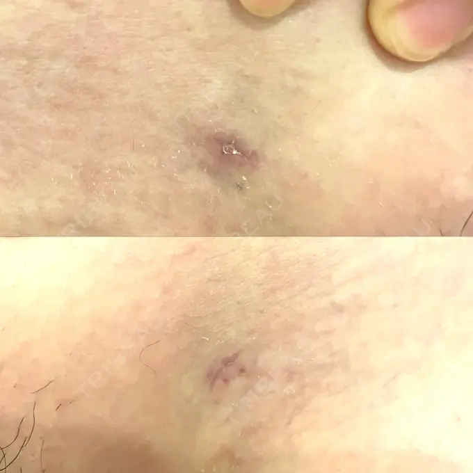 脂肪吸引（お腹） / 脂肪吸引（背中） WOM CLINIC GINZA （ワム クリニック ギンザ） DAY 24 メイン用