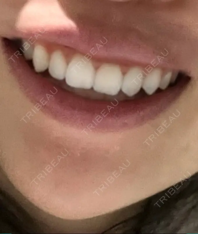 ボトックス（ガミースマイル） 椿クリニック 心斎橋院 DAY 16 メイン用