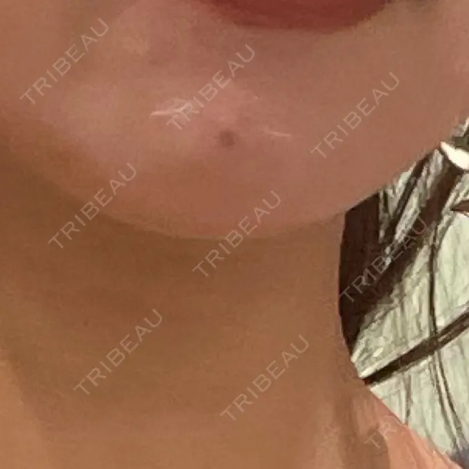 ほくろ・いぼ切除（肌） 美容皮膚科エルムクリニック 福岡院 DAY 3 メイン用