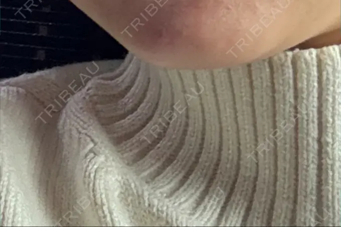 ほくろ・いぼ切除（肌） 美容皮膚科エルムクリニック 福岡院 AFTER メイン用