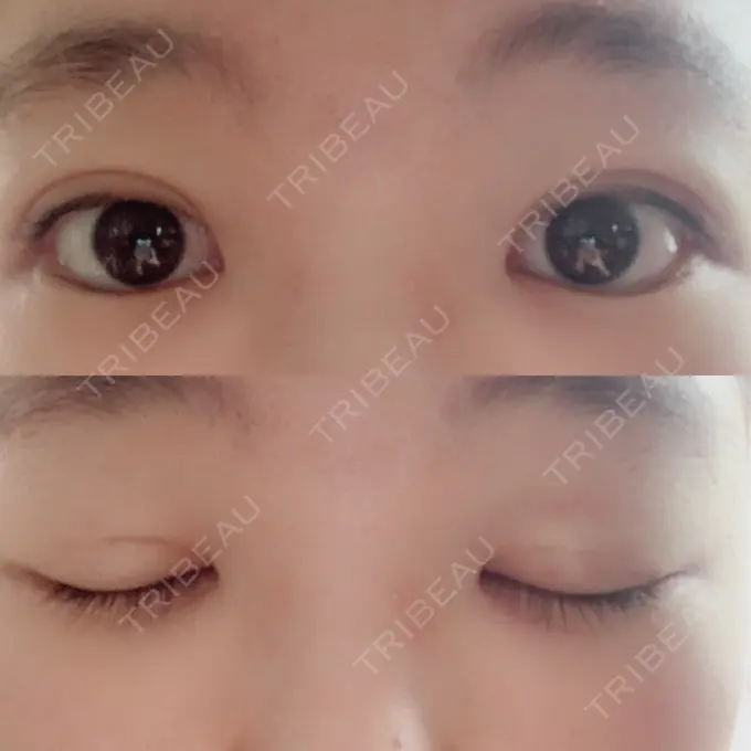 二重埋没 湘南美容クリニック 仙台院 DAY 13 メイン用