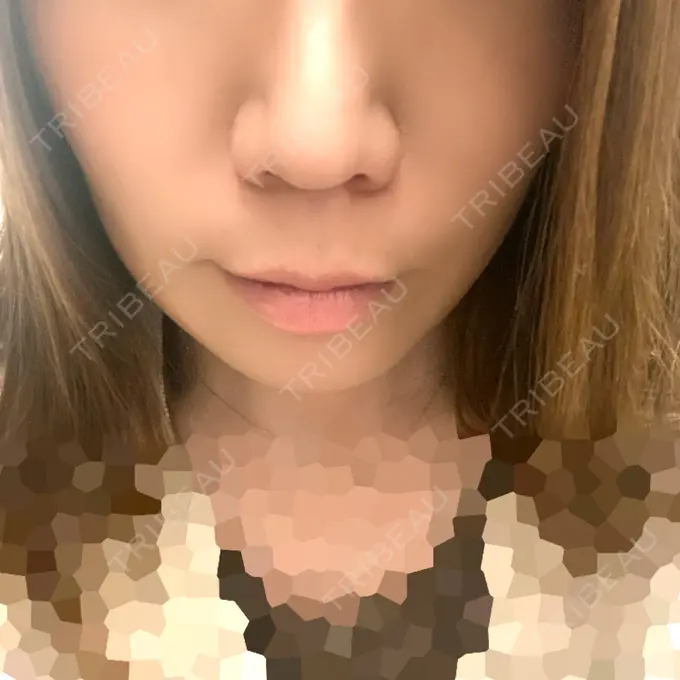 ボトックス（人中） veary clinic DAY 4 メイン用