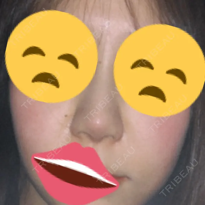 隆鼻術 / 鼻尖形成（切開） / 小鼻縮小（切開） / 軟骨移植 / 鼻翼挙上 / 鼻柱下降・鼻唇角形成（猫手術） Designo Clinic （デジーノクリニック） DAY 18 メイン用