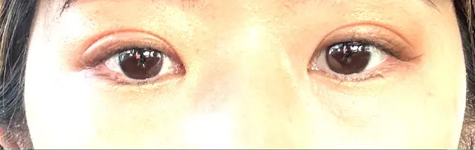 二重埋没 銀座S美容・形成外科クリニック DAY 65 メイン用