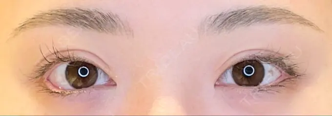 目尻切開 / タレ目形成・グラマラスライン（埋没） LOUIS CLINIC 二子玉川院【ルイクリニック】 AFTER メイン用