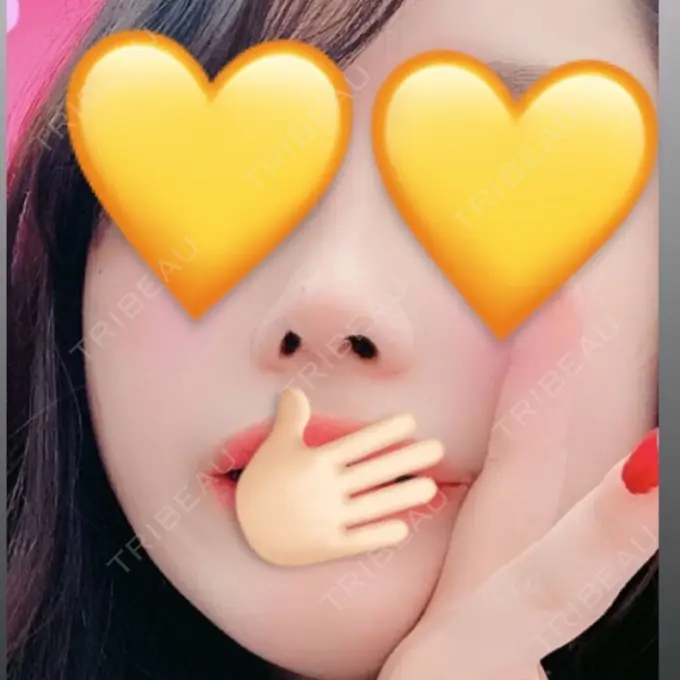 小鼻縮小（切開） / その他（鼻） FROM B整形外科 (旧バウム整形外科) DAY 29 メイン用