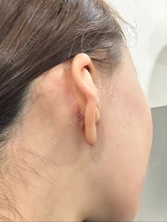 シワ取りボトックス ドクタープチ美容クリニック -江南店 AFTER メイン用