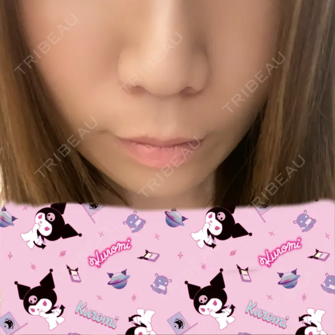 ボトックス（人中） veary clinic DAY 5 メイン用