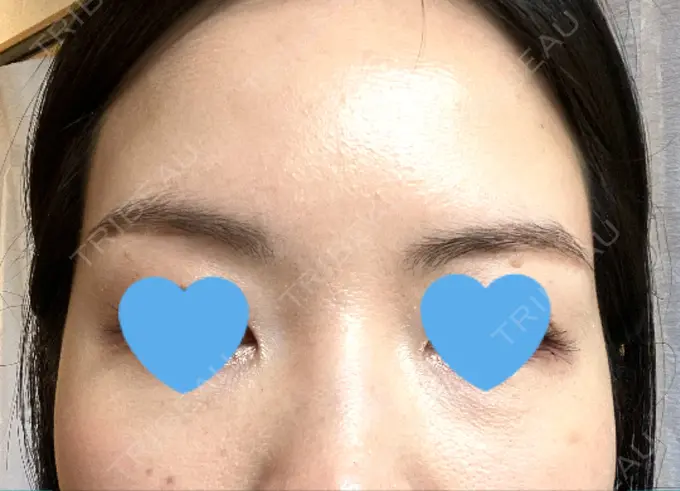 ボトックス（眉間） / ボトックス（額） TCB東京中央美容外科 自由が丘院 DAY 13 メイン用