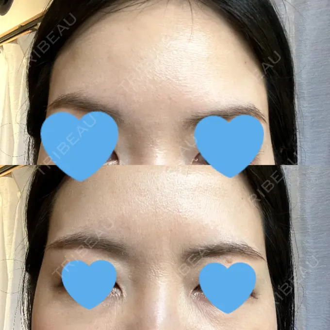 ボトックス（眉間） / ボトックス（額） TCB東京中央美容外科 自由が丘院 DAY 13 メイン用