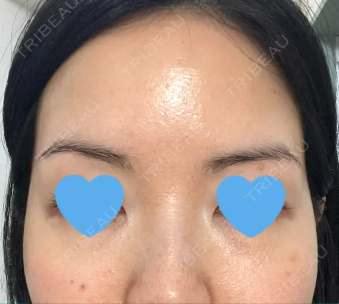 ボトックス（眉間） / ボトックス（額） TCB東京中央美容外科 自由が丘院 DAY 15 メイン用