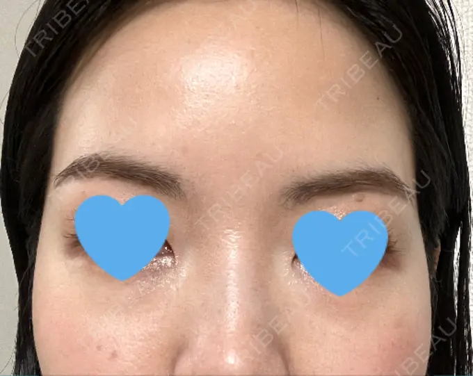 ボトックス（眉間） / ボトックス（額） TCB東京中央美容外科 自由が丘院 DAY 15 メイン用