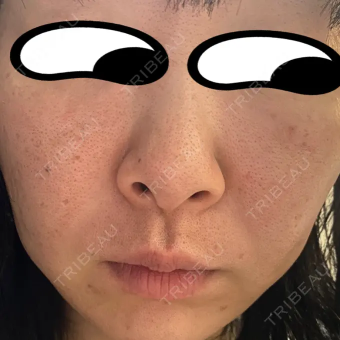 光治療（フォトフェイシャルなど） KM新宿クリニック AFTER メイン用